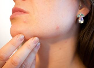 Types Of Acne, Symptoms And Treatments