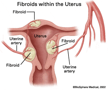 Uterine Fibroids 2