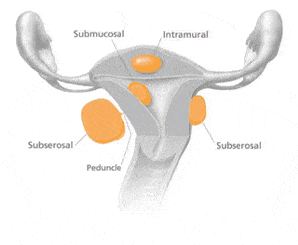 Uterine Fibroids 3