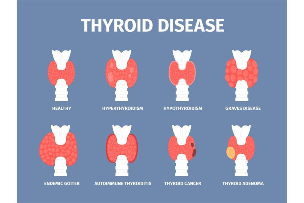 What Kinds Of Thyroid Disease Affect Women?