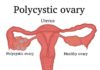 Polycystic Ovarian Syndrome (Pcos)