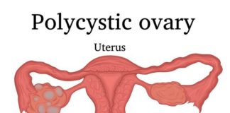 Polycystic Ovarian Syndrome (PCOS)