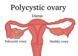 Polycystic Ovarian Syndrome (Pcos)