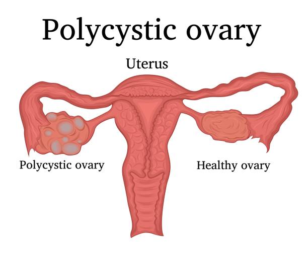 Polycystic Ovarian Syndrome (PCOS)