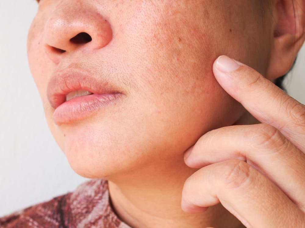 Pcos Symptoms - Acne Rash